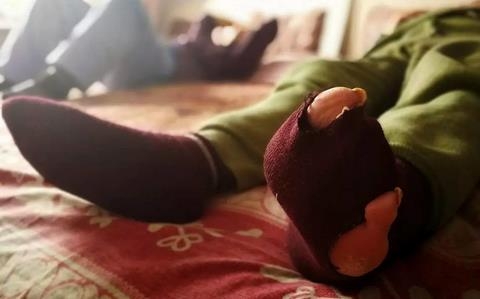 照顾病弟终身未娶 年轻时无名指被夹断手筋断掉