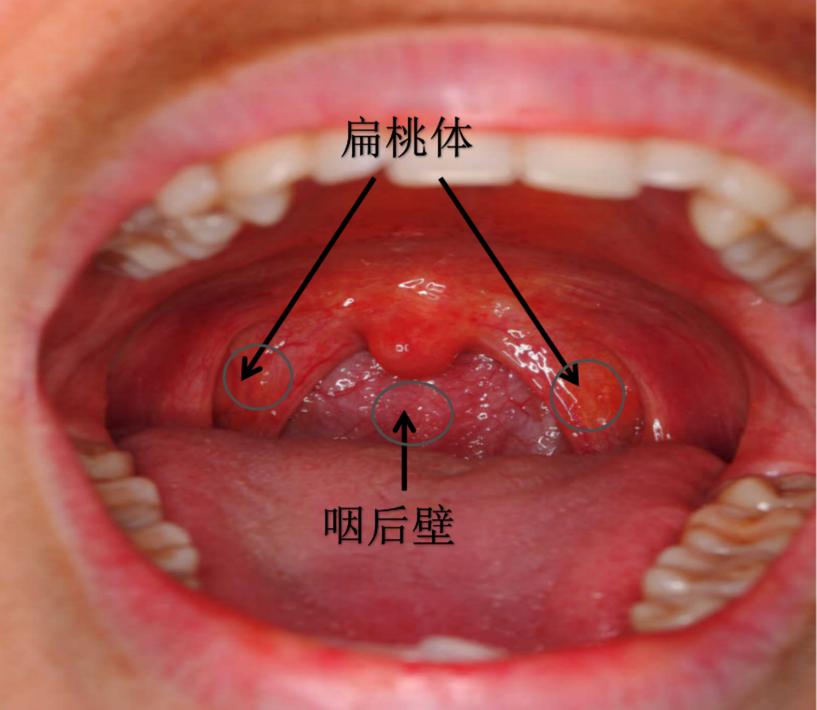 正常人的喉咙后壁图片图片