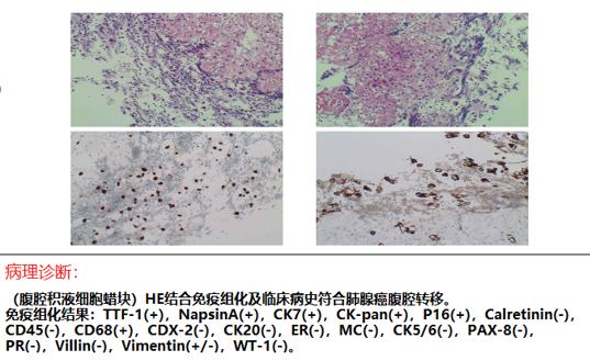 並確認患者為肺腺癌轉移